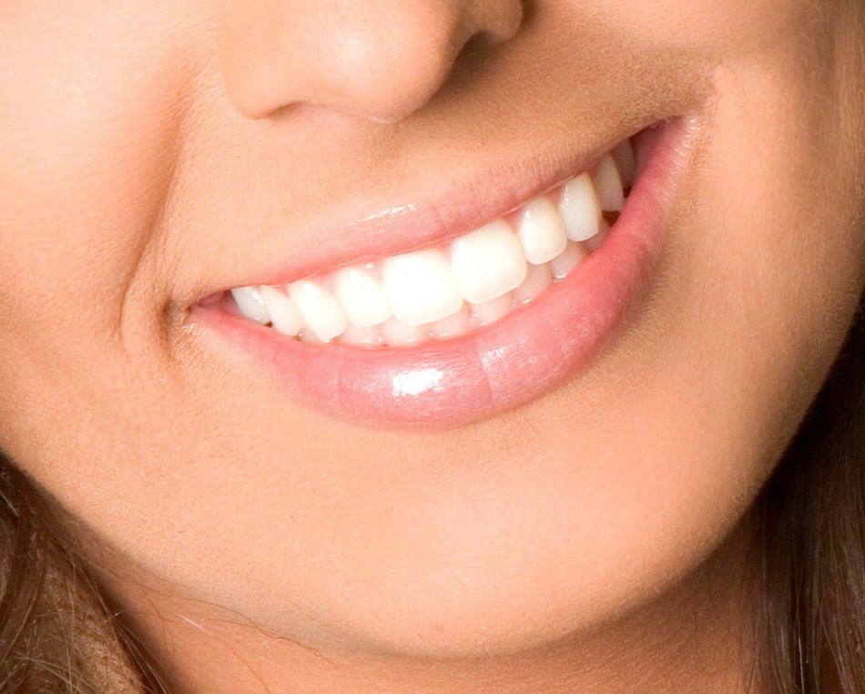 Custom night guard for bruxism and teeth grinding treatment in Calgary NE