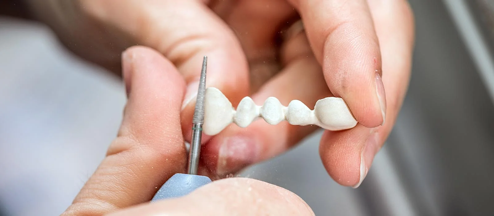 Dental bridge procedure at The Port Dental Clinic Calgary NE