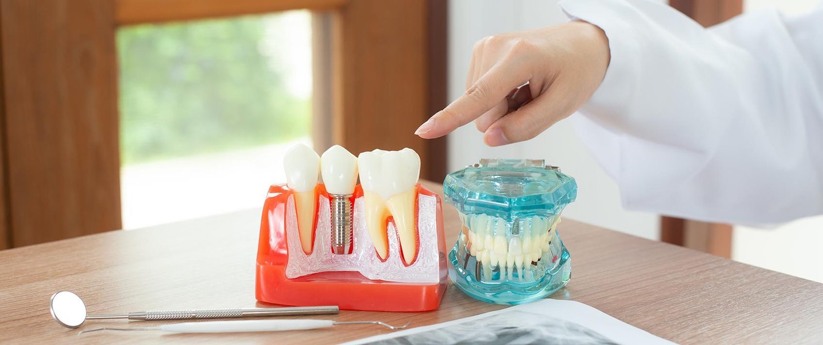 Dental implant model showing titanium post, abutment, and crown