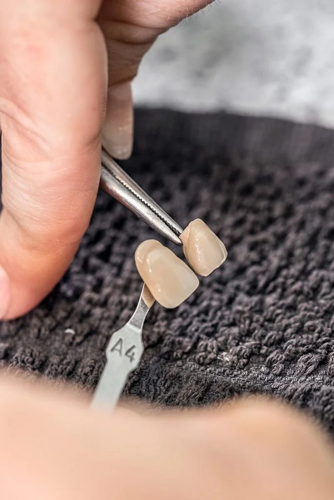 Porcelain veneer shade selection and colour matching at The Port Dental Clinic Calgary NE